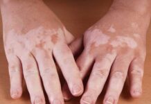 Entenda o que é o vitiligo