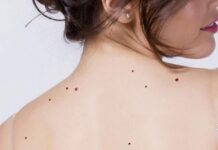 Você sabe o que são angiomas? Entenda o que é e como tratar