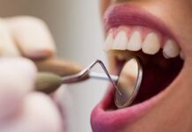 UNIFAL recruta voluntários para tratamento de recessão gengival tratamento dentário Unifal